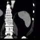 Hemangioma of spleen, splenic hemangioma: CT - Computed tomography
