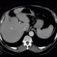 Hemangioma of spleen, splenic hemangioma: CT - Computed tomography