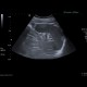 Hemangioma of spleen, splenic hemangioma: US - Ultrasound