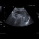 Hemangioma of spleen, splenic hemangioma: US - Ultrasound