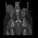 Hemangioma of pelvis and vertebra: CT - Computed tomography