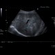 Liver hematoma: US - Ultrasound