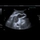 Hematoma after repair of inguinal hernia: US - Ultrasound