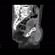 Repair of inguinal hernia, hematoma, mimic of recurrence: CT - Computed tomography
