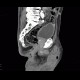 Repair of inguinal hernia, hematoma, mimic of recurrence: CT - Computed tomography