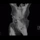 Repair of inguinal hernia, hematoma, mimic of recurrence: CT - Computed tomography
