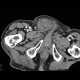 Repair of inguinal hernia, hematoma, mimic of recurrence: CT - Computed tomography