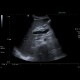 Hepatitis, lues: US - Ultrasound
