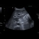 Hepatitis, lues: US - Ultrasound