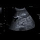 Hepatitis, lues: US - Ultrasound