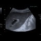 Hepatitis, lues: US - Ultrasound