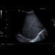 Hepatitis, lues: US - Ultrasound