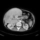 Hereditary hemochromatosis: CT - Computed tomography