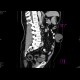 Scar hernia after laparoscopy: CT - Computed tomography