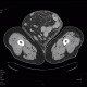 Scrotal hernia: CT - Computed tomography