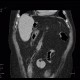 Scrotal hernia: CT - Computed tomography