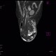 Scrotal hernia: CT - Computed tomography