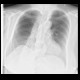 Hiatal hernia: X-ray - Plain radiograph
