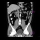 Hiatal hernia: CT - Computed tomography