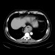 Hiatal hernia: CT - Computed tomography