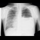Hydropneumothorax, pneumothorax: X-ray - Plain radiograph