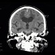 Leukoaraiosis, atherosclerotic encephalopathy, periventricular atrophy, hydrocephalus e vacuo: CT - Computed tomography