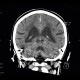 Leukoaraiosis, atherosclerotic encephalopathy, periventricular atrophy, hydrocephalus e vacuo: CT - Computed tomography