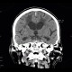 Leukoaraiosis, atherosclerotic encephalopathy, periventricular atrophy, hydrocephalus e vacuo: CT - Computed tomography