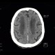 Leukoaraiosis, atherosclerotic encephalopathy, periventricular atrophy, hydrocephalus e vacuo: CT - Computed tomography