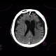 Subdural hygroma: CT - Computed tomography