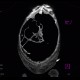 Hydropneumoperitoneum, pneumoperitoneum, ascites, Rigler's sign: CT - Computed tomography