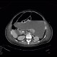Hydropneumoperitoneum, pneumoperitoneum, ascites, Rigler's sign: CT - Computed tomography