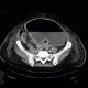 Hydropneumoperitoneum, pneumoperitoneum, ascites, Rigler's sign: CT - Computed tomography