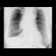 Fluidopneumothorax: X-ray - Plain radiograph