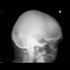 Frontal hyperostosis: X-ray - Plain radiograph
