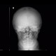 Frontal hyperostosis: X-ray - Plain radiograph