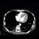 Hypertrophic cardiomyopathy: CT - Computed tomography