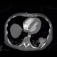 Hypertrophic cardiomyopathy: CT - Computed tomography