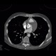 Hypertrophic cardiomyopathy: CT - Computed tomography