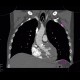 Hypertrophic cardiomyopathy: CT - Computed tomography