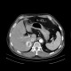 Liver metastasis of renal cell carcinoma, RFA: CT - Computed tomography
