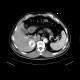 Liver metastasis of renal cell carcinoma, RFA: CT - Computed tomography
