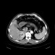 Liver metastasis of renal cell carcinoma, RFA: CT - Computed tomography