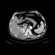 Liver metastasis of renal cell carcinoma, RFA: CT - Computed tomography