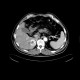 Liver metastasis of renal cell carcinoma, RFA: CT - Computed tomography