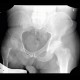 Hypoplasia of pelvis in DMO: X-ray - Plain radiograph