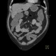 Ileocecal resection, postinflammatory changes of neoterminal ileum, CT enterography: CT - Computed tomography