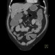 Ileocecal resection, postinflammatory changes of neoterminal ileum, CT enterography: CT - Computed tomography