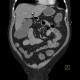 Ileocecal resection, postinflammatory changes of neoterminal ileum, CT enterography: CT - Computed tomography