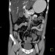 Thrombosis of superior mesenteric vein, infarsation of small bowel: CT - Computed tomography